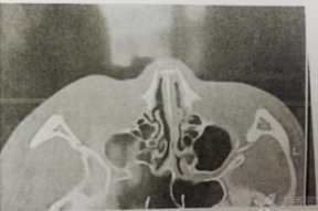 鼻骨骨折图片,鼻骨骨折影像学特征解析